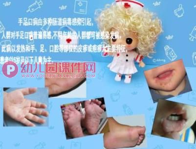 大班健康课件PPT《预防手足口病》PPT课件图片